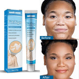 Manchas Brancas Creme Vitiligo Pomada Tratamento Reparação Leucoplasia Reduzir Pigmento Melanina Antibacteriano Hidratante Cuidados com a Pele