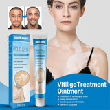 Manchas Brancas Creme Vitiligo Pomada Tratamento Reparação Leucoplasia Reduzir Pigmento Melanina Antibacteriano Hidratante Cuidados com a Pele