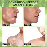 Manchas Brancas Creme Vitiligo Pomada Tratamento Reparação Leucoplasia Reduzir Pigmento Melanina Antibacteriano Hidratante Cuidados com a Pele